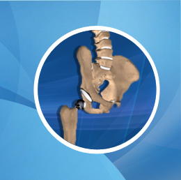 What is an anterior hip replacement?