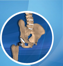 Anterior Hip Replacement