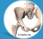 What is Anterior Hip Replacement